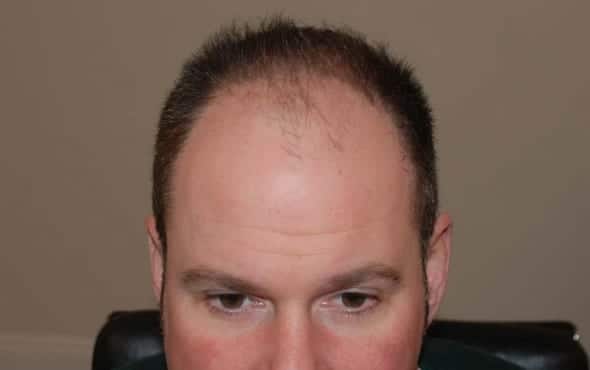 Before hair transplant