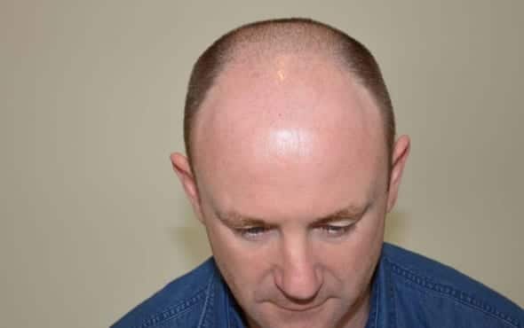 Before hair transplant