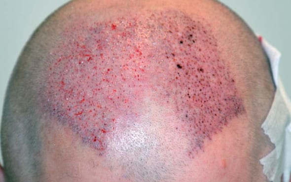 After Hair Transplant