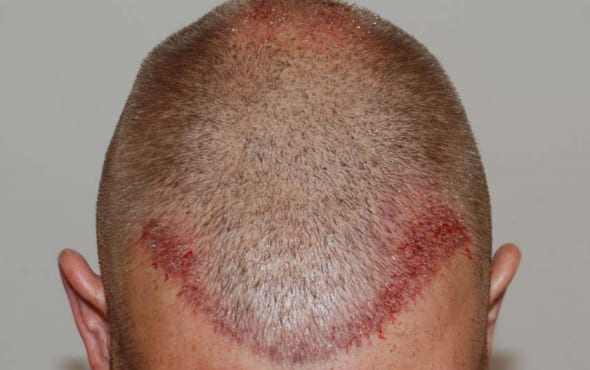 Hair transplant after