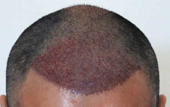 Hair transplant after