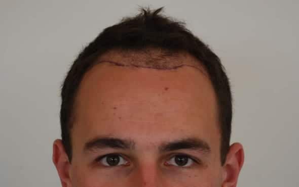 Before hair transplant