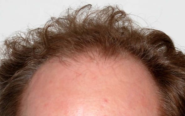 Before hair transplant