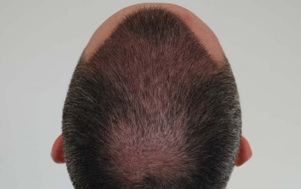 After hair transplant