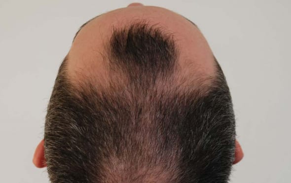 Before hair transplant