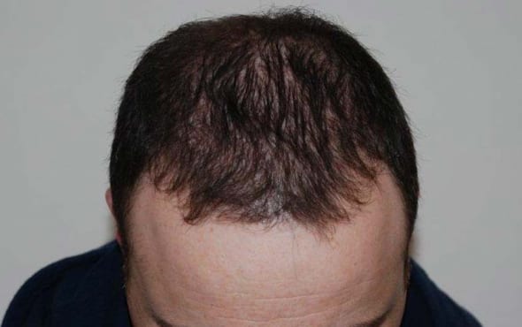 Hair transplant after
