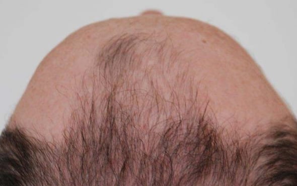 Hair transplant before