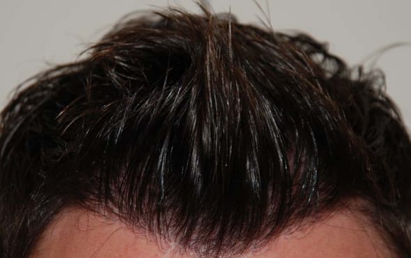 After hair transplant