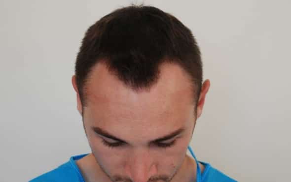 Patient 22's Hair Transplant Results - Harley Street Hair Clinic