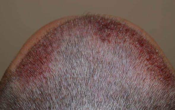 After hair transplant