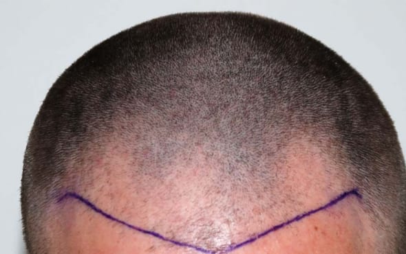 Before hair transplant