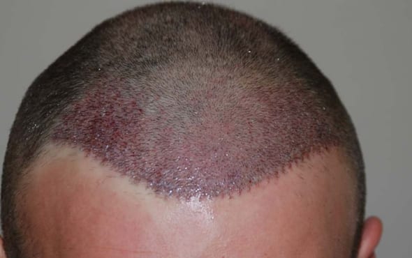 After hair transplant