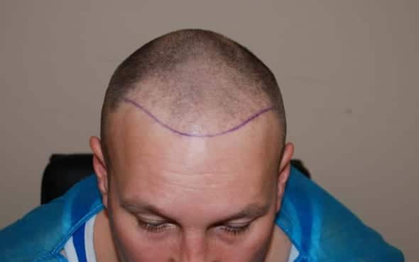 Before hair transplant