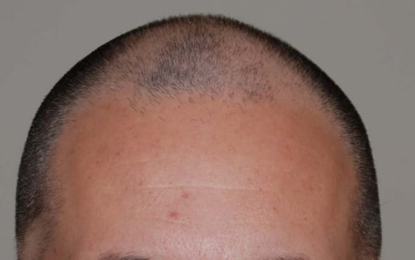 Before hair transplant