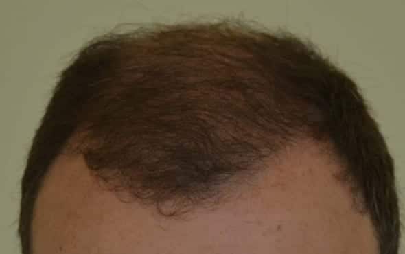 Patient 27's Hair Transplant Results - Harley Street Hair Clinic