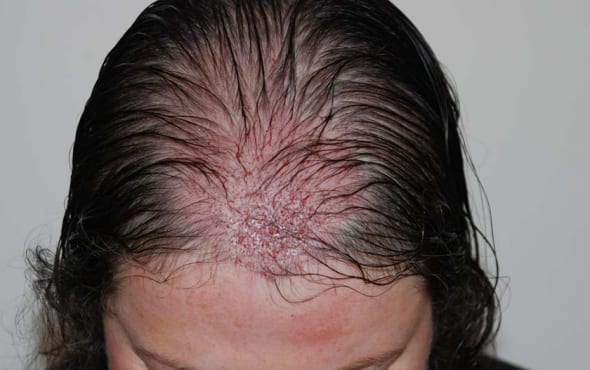 After hair transplant woman