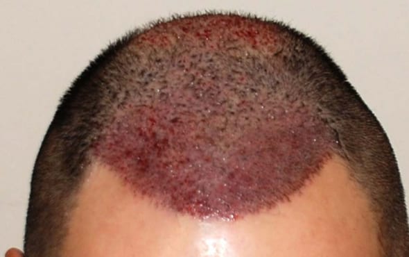 Hair transplant after