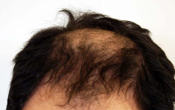 Hair transplant before