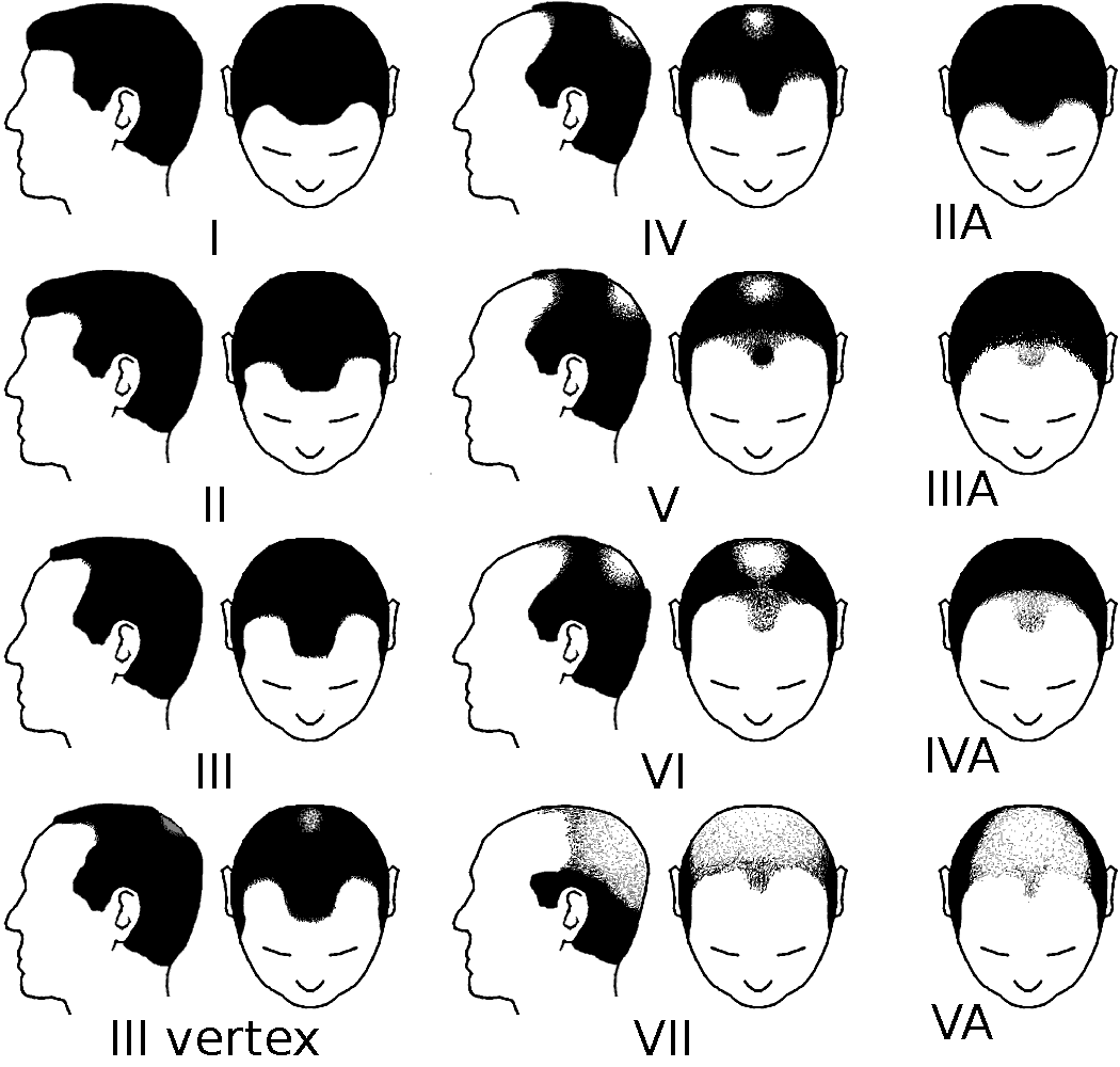 The Norwood Scale