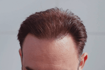 Hair transplant results