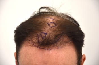 Hair transplant Before