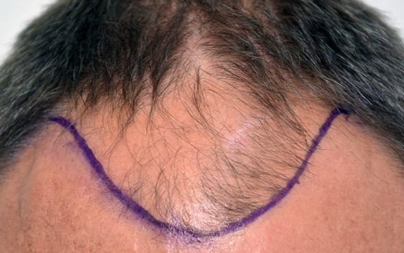 Before hair transplant