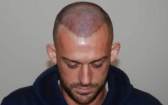 Steven Fletcher Hair Transplant