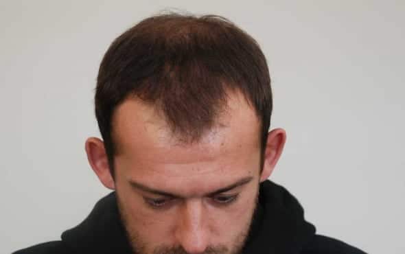 Steven Fletcher Hair Transplant