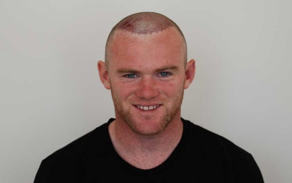 Wayne Rooney Hair Transplant