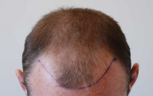 Wayne Rooney Hair Transplant