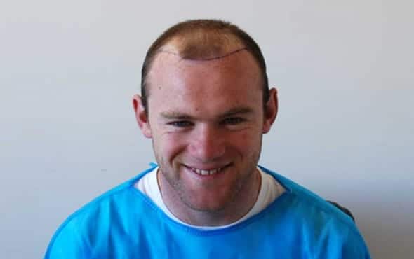 Wayne Rooney  Hair Transplant  YouTube