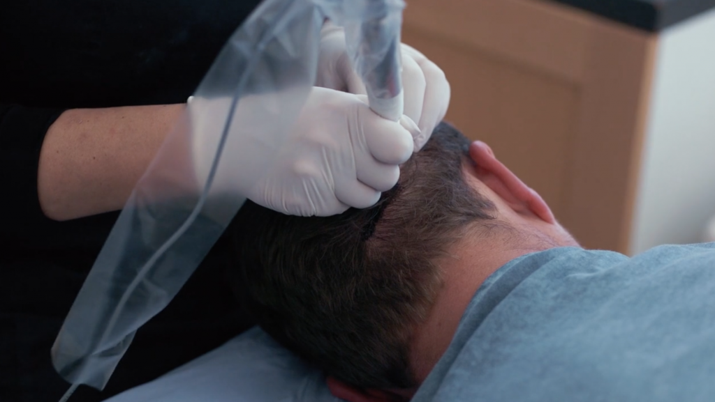 Man getting hair transplant at back of head