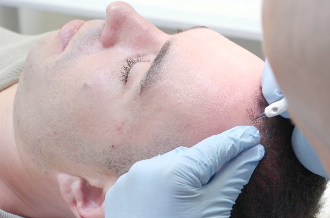 Man getting Hair Transplant in progress