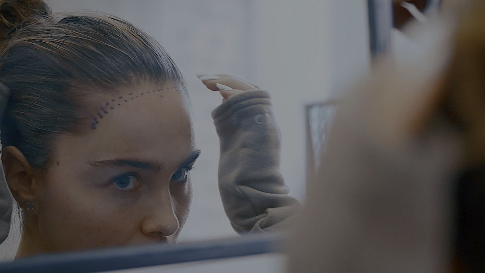 Harley street hair clinic hair transplant