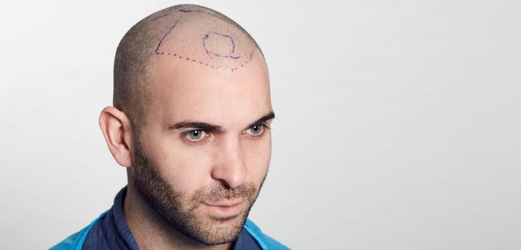 Man with Hair Transplant Mapped Out