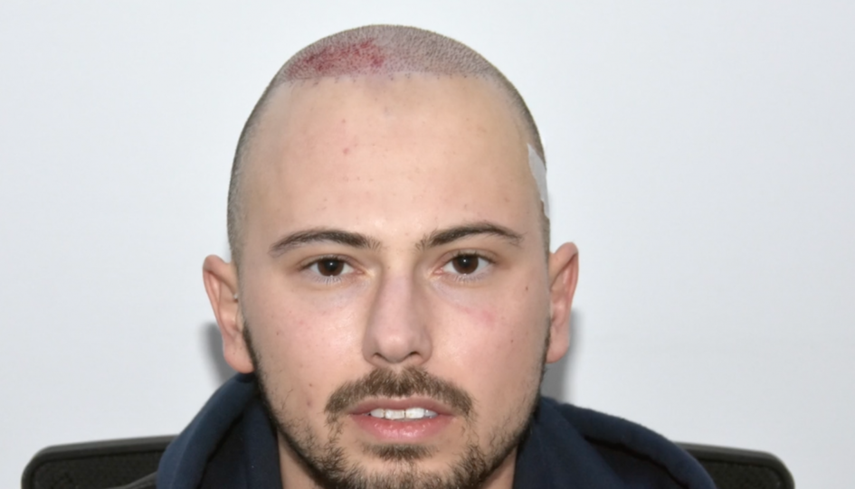 After hair transplant