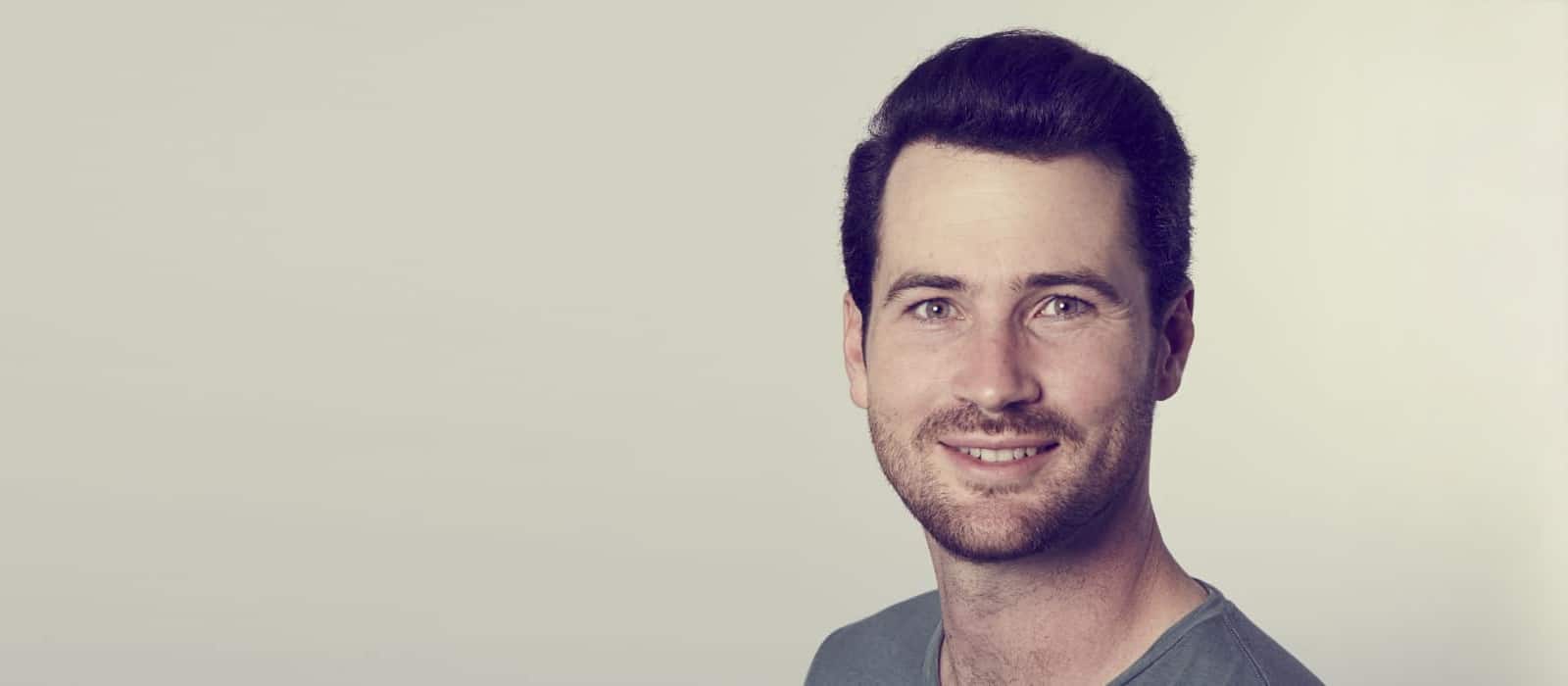 Paul’s Hair Transplant Results