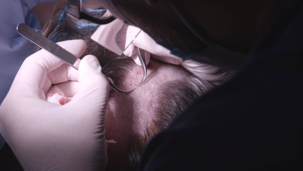 Hair transplant procedure