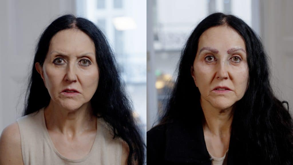 before and after eyebrow transplant