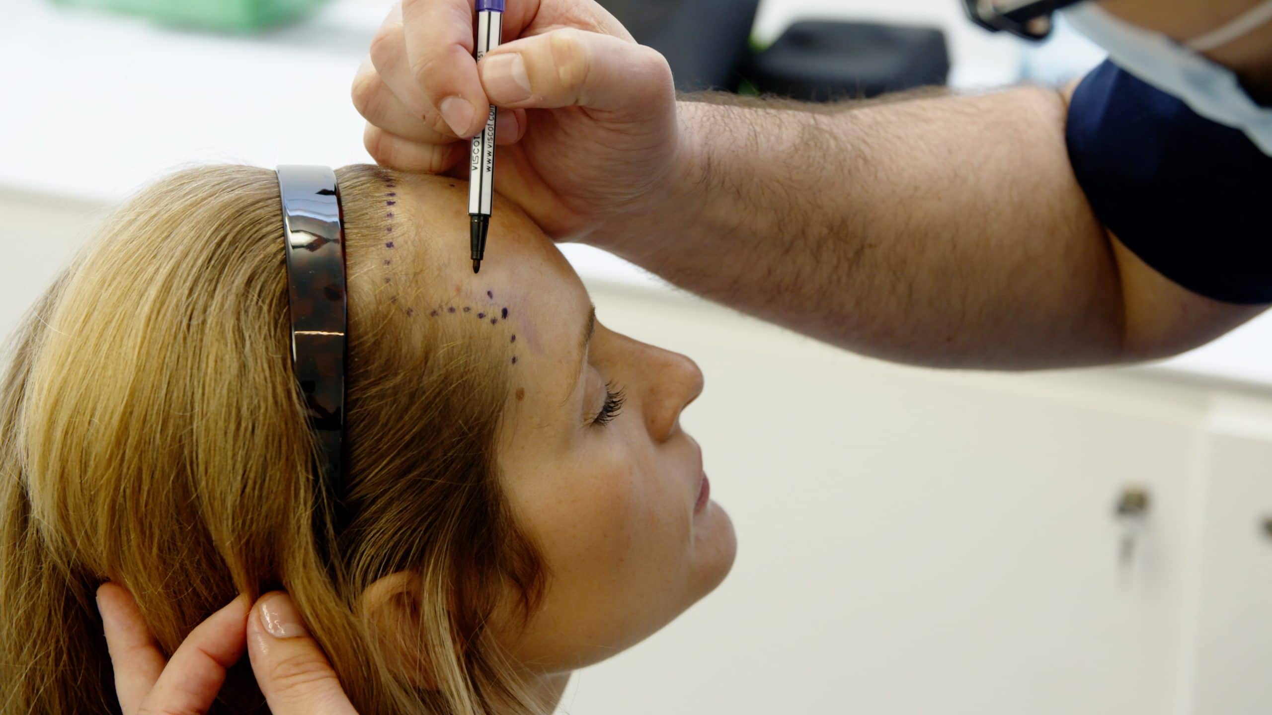 Female hairline reconstruction