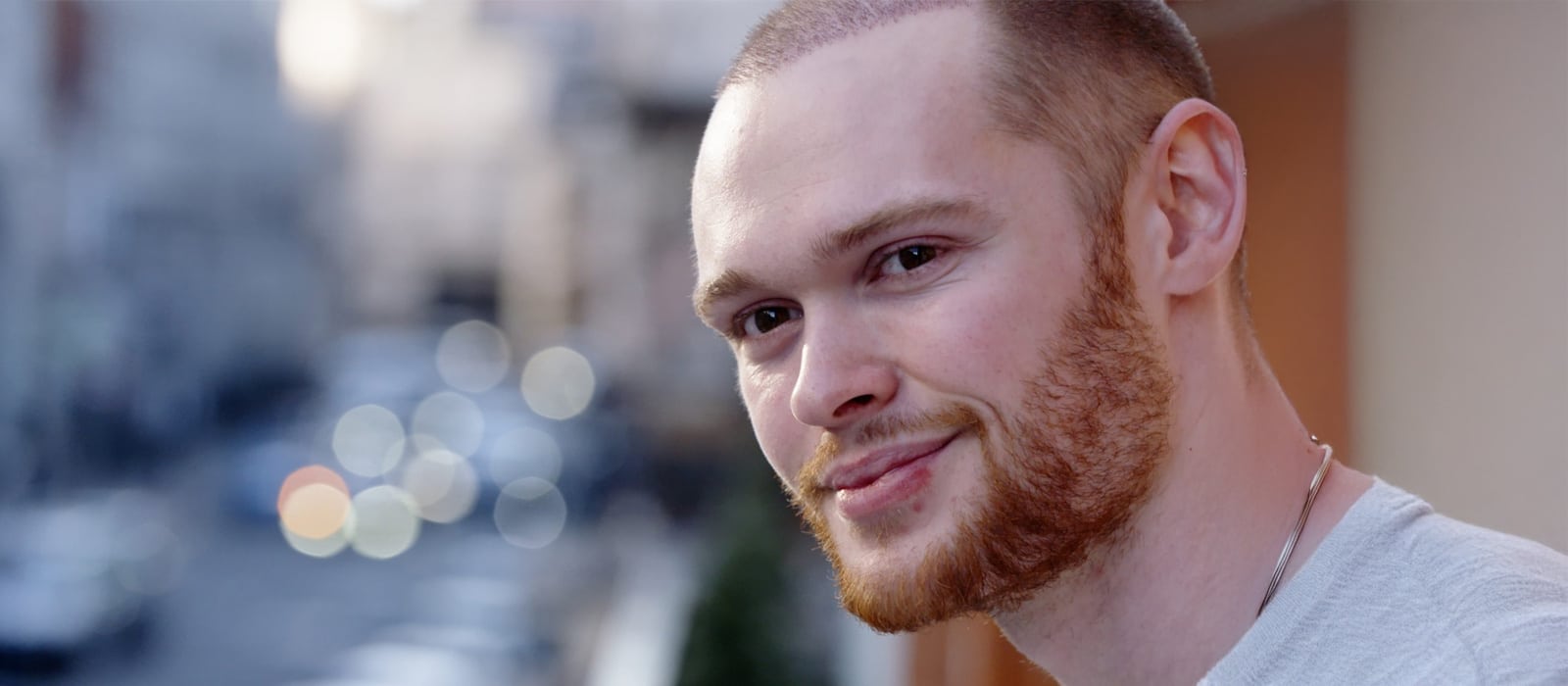 Conor’s Hair Transplant Results