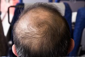 Crown Hair Loss