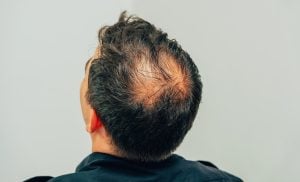 Crown hair loss