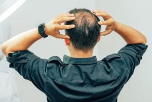 Crown hair loss