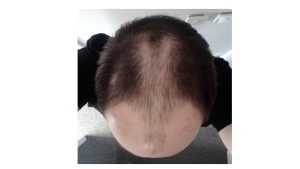 Before image of FUE hair transplant recipient Wes
