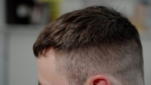 After image of FUE hair transplant recipient Wes