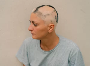 Female Alopecia