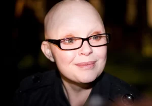 Gail Porter Alopecia