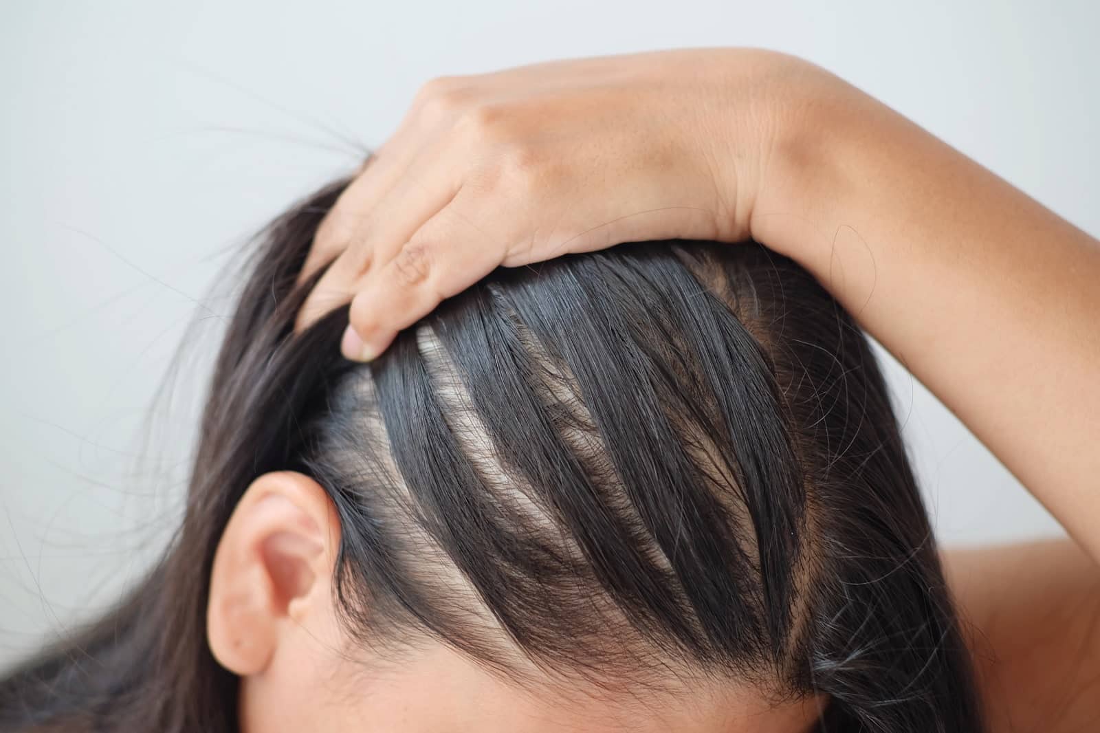 female thinning hair