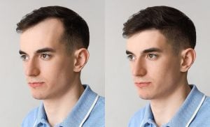 Hair transplant